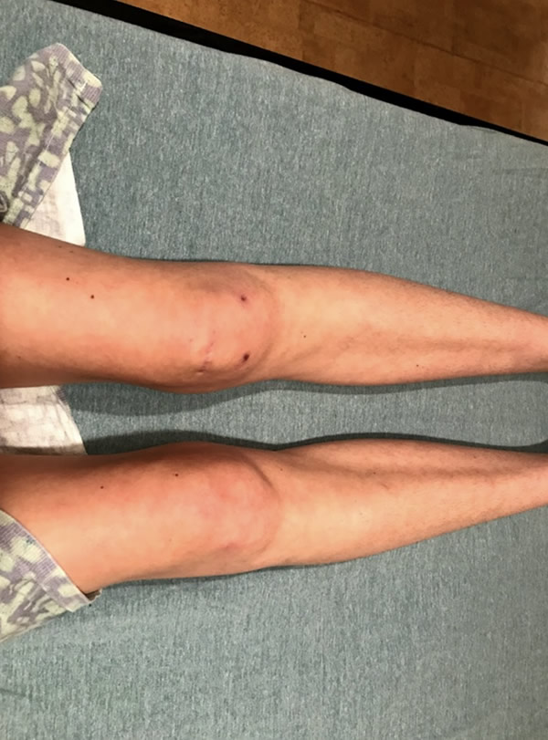 Cheering for Alexis and the Start of Her New Family Post Knee Surgery