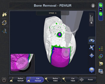 CORI Total Joint Replacement
